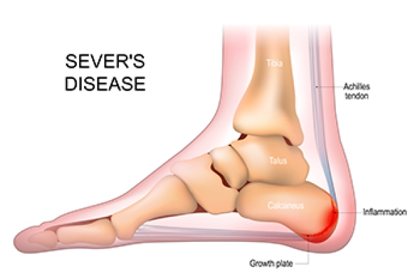 Sever s Disease and Children s Heel Pain